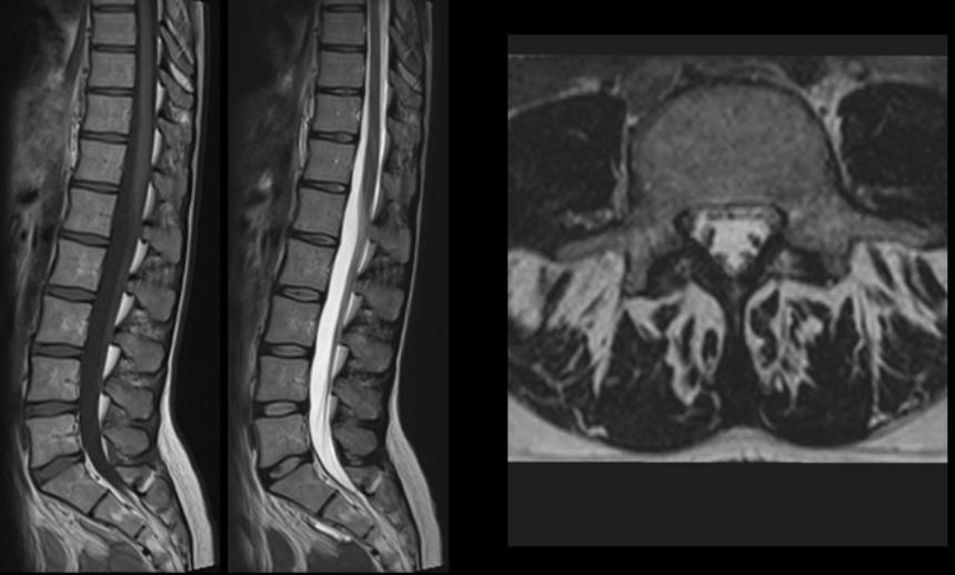 Spine MRI